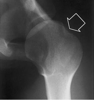38种特殊类型的骨折