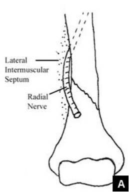 38种特殊类型的骨折