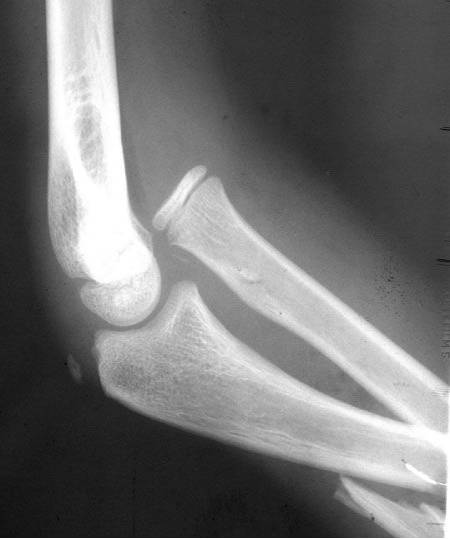 38种特殊类型的骨折