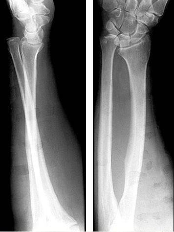 38种特殊类型的骨折