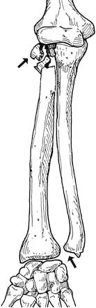 38种特殊类型的骨折