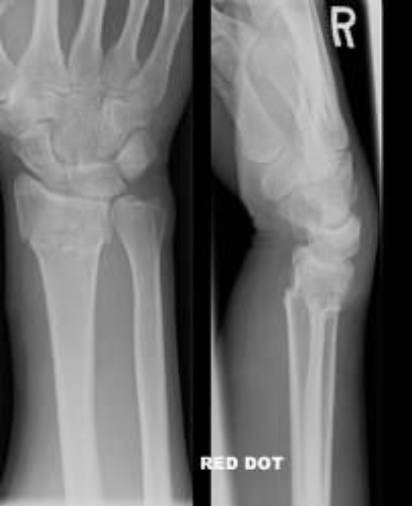 38种特殊类型的骨折