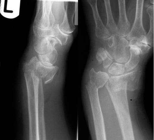 38种特殊类型的骨折