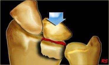 38种特殊类型的骨折