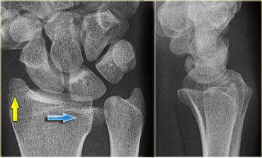 38种特殊类型的骨折