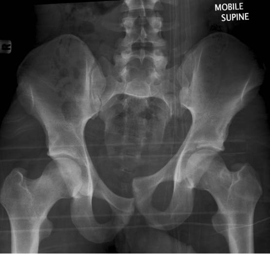 38种特殊类型的骨折