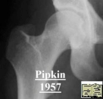 38种特殊类型的骨折