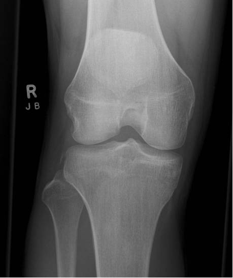 38种特殊类型的骨折