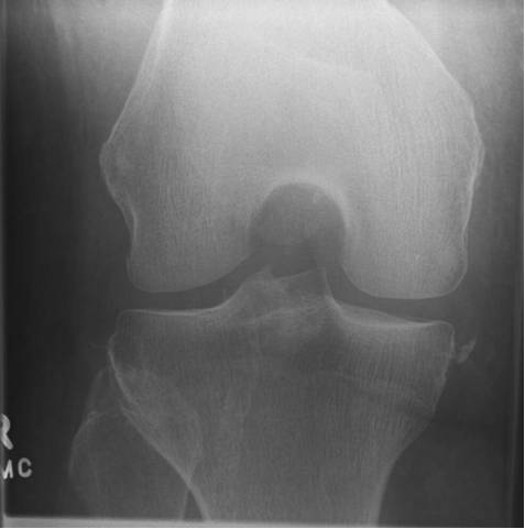 38种特殊类型的骨折