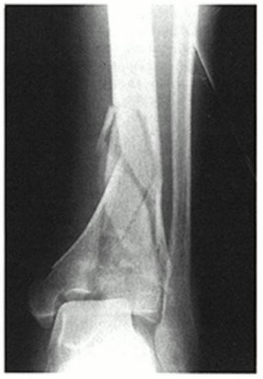 38种特殊类型的骨折