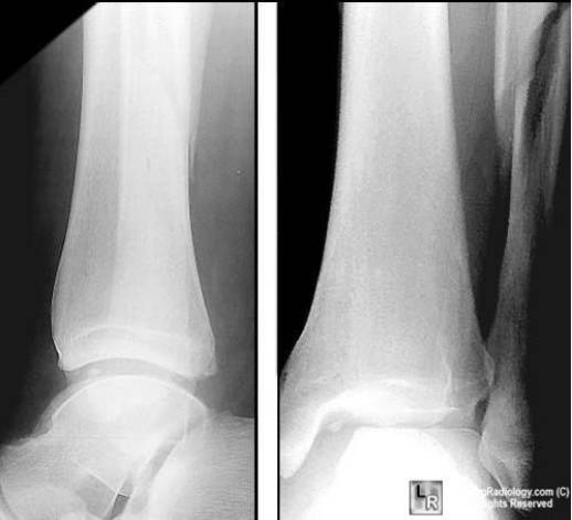 38种特殊类型的骨折