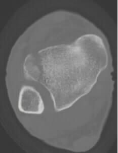 38种特殊类型的骨折