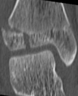 38种特殊类型的骨折