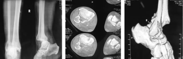 38种特殊类型的骨折
