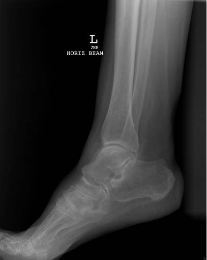 38种特殊类型的骨折