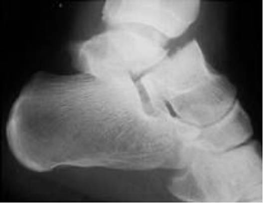 38种特殊类型的骨折