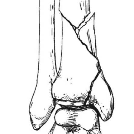 38种特殊类型的骨折