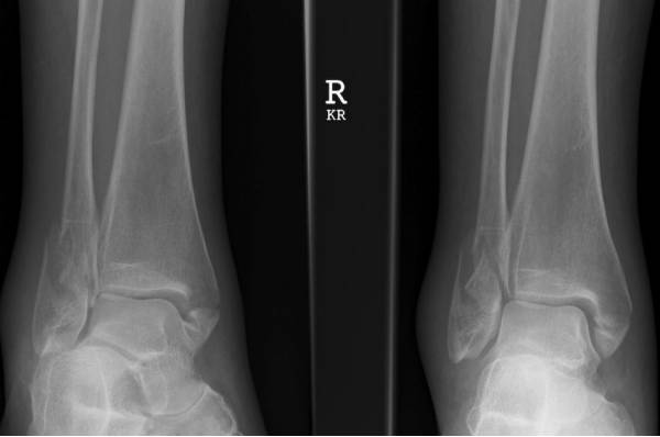 38种特殊类型的骨折