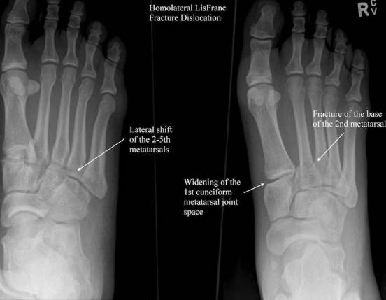 38种特殊类型的骨折