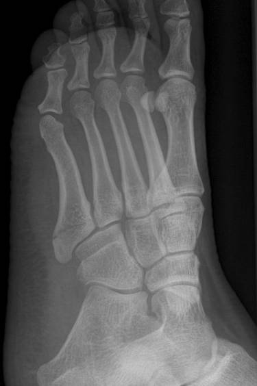 38种特殊类型的骨折