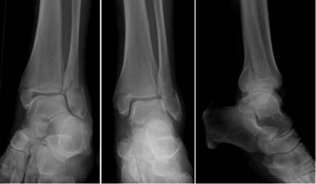 38种特殊类型的骨折