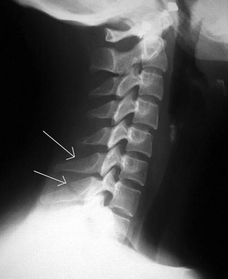38种特殊类型的骨折