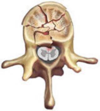 38种特殊类型的骨折
