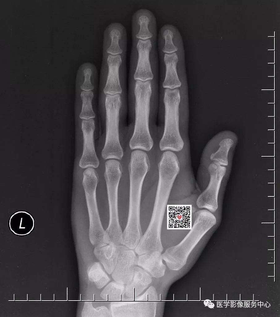 一不小心就漏诊的骨折，做到这三点便可尽量减少漏诊