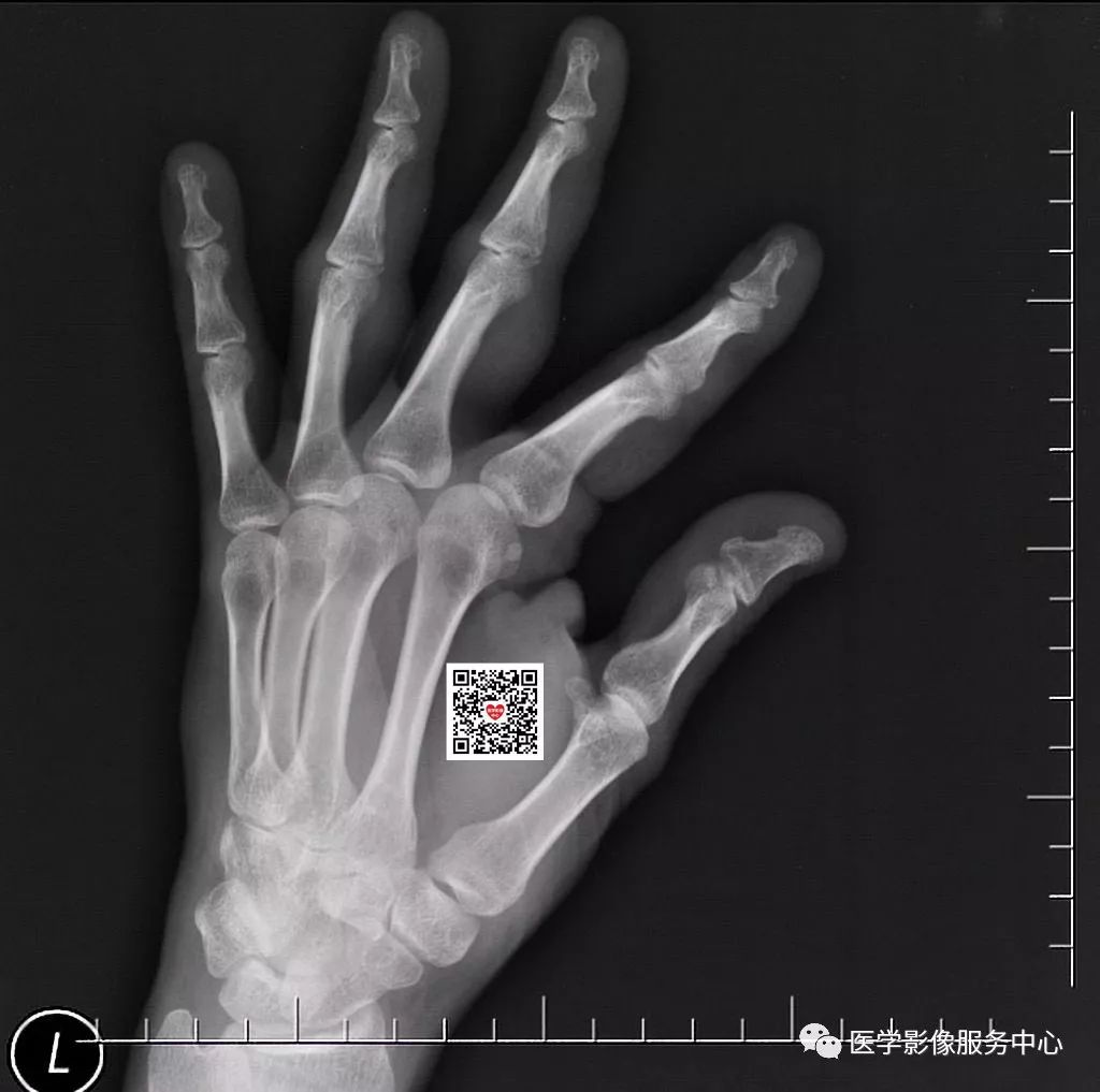 一不小心就漏诊的骨折，做到这三点便可尽量减少漏诊