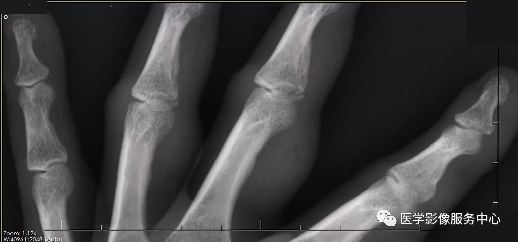 一不小心就漏诊的骨折，做到这三点便可尽量减少漏诊