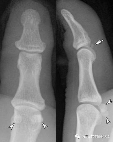 手X线的正常表现、常见变异及病变鉴别