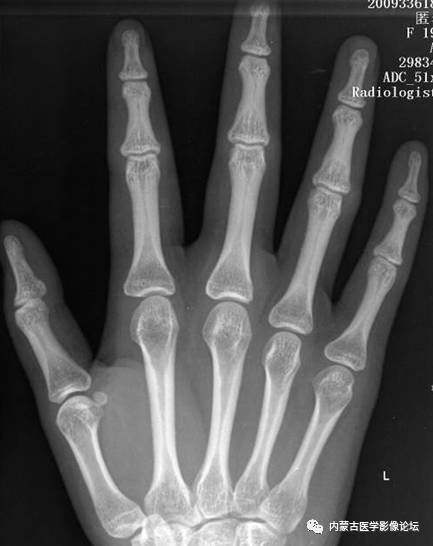 手X线的正常表现、常见变异及病变鉴别
