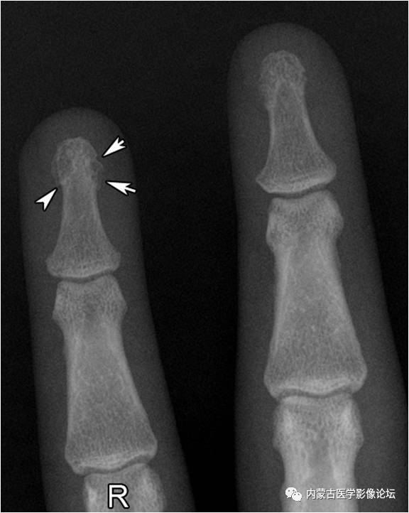 手X线的正常表现、常见变异及病变鉴别
