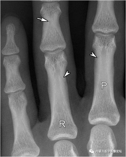 手X线的正常表现、常见变异及病变鉴别