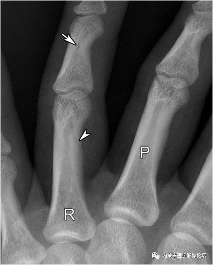 手X线的正常表现、常见变异及病变鉴别