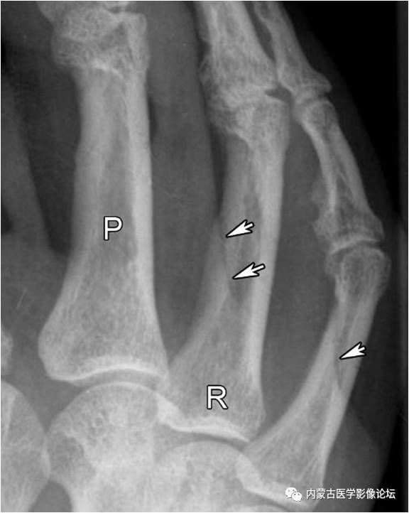 手X线的正常表现、常见变异及病变鉴别