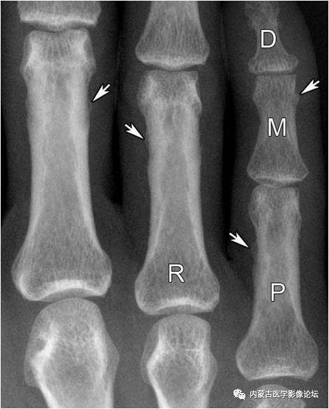 手X线的正常表现、常见变异及病变鉴别