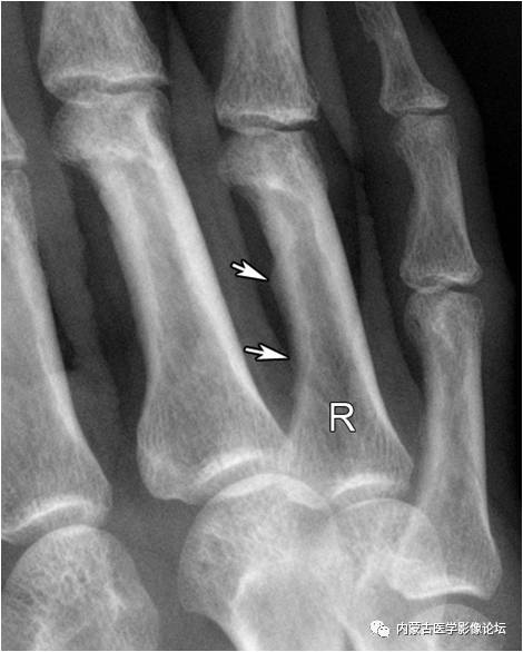 手X线的正常表现、常见变异及病变鉴别