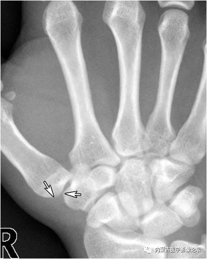 手X线的正常表现、常见变异及病变鉴别