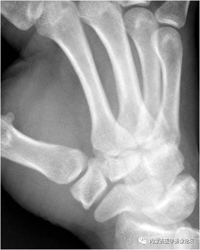手X线的正常表现、常见变异及病变鉴别