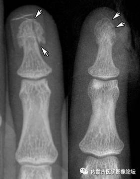 手X线的正常表现、常见变异及病变鉴别