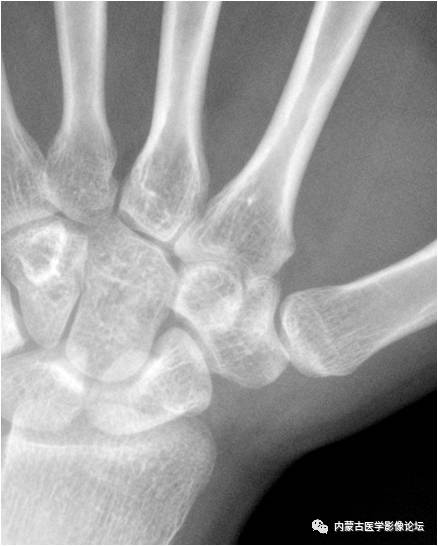 手X线的正常表现、常见变异及病变鉴别