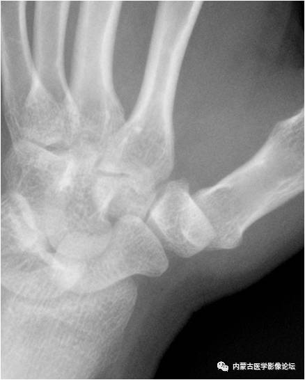 手X线的正常表现、常见变异及病变鉴别