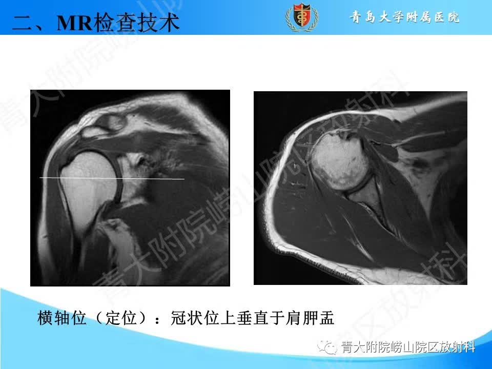 【PPT】肩关节运动损伤的MRI诊断