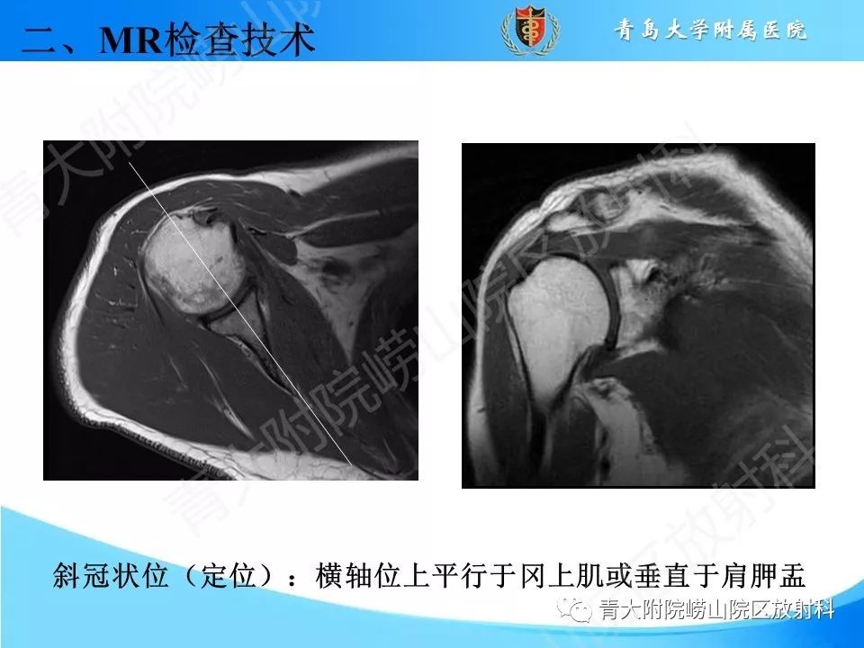 【PPT】肩关节运动损伤的MRI诊断