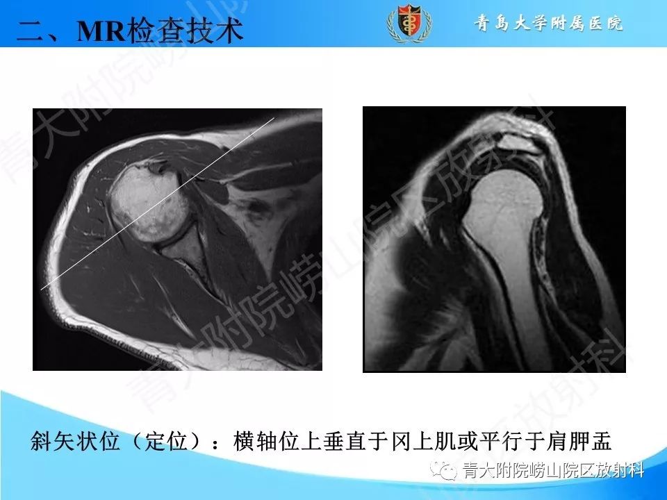 【PPT】肩关节运动损伤的MRI诊断