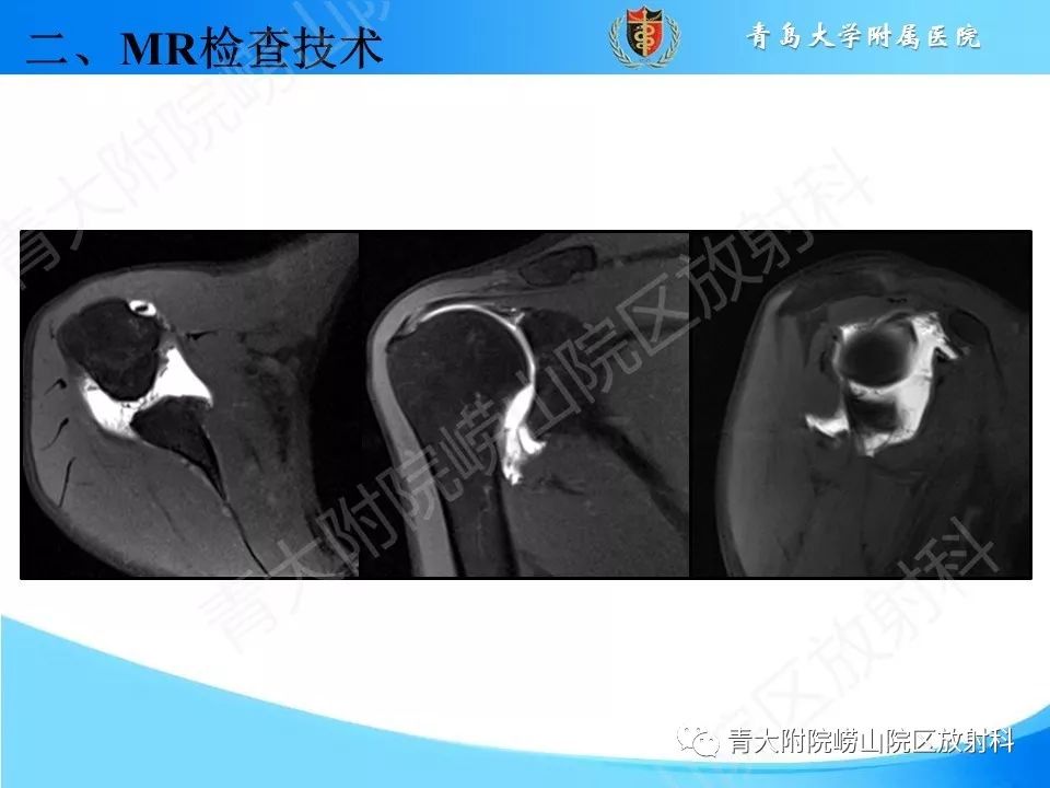 【PPT】肩关节运动损伤的MRI诊断