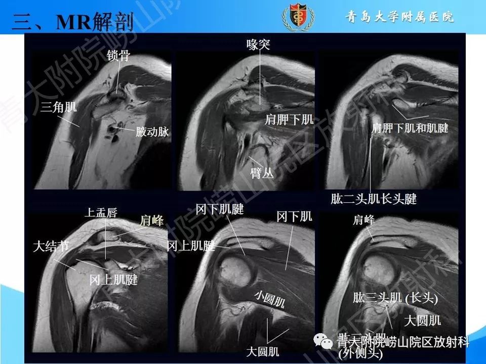 【PPT】肩关节运动损伤的MRI诊断