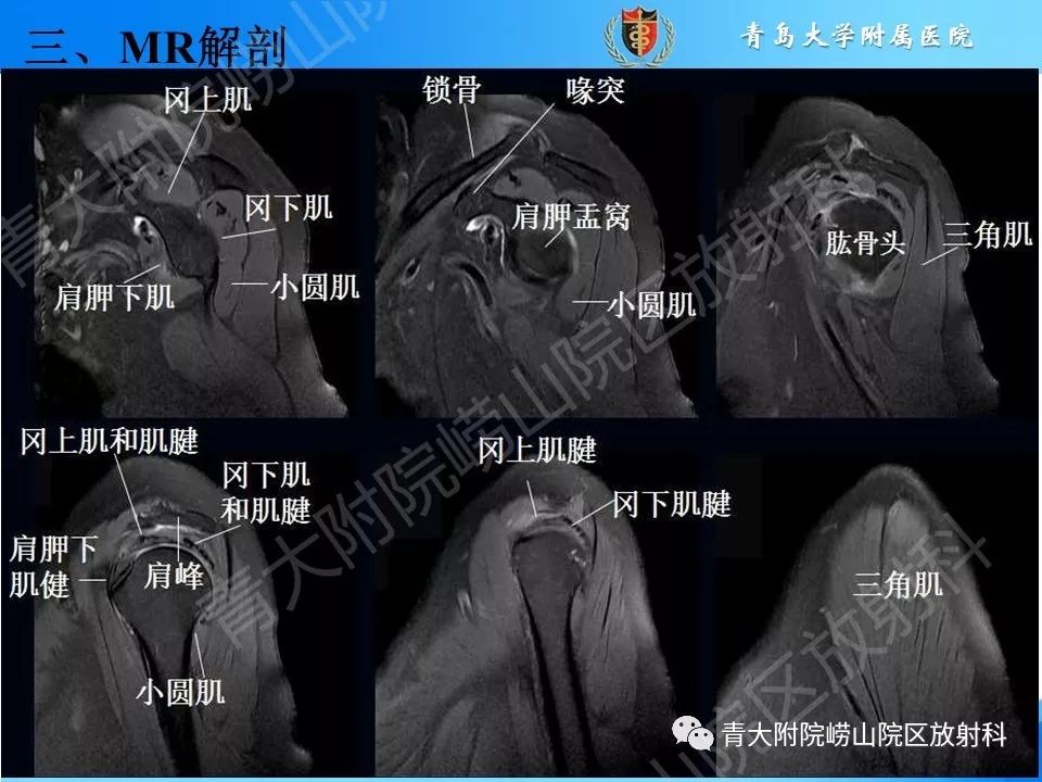 【PPT】肩关节运动损伤的MRI诊断