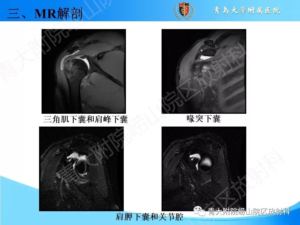 【PPT】肩关节运动损伤的MRI诊断